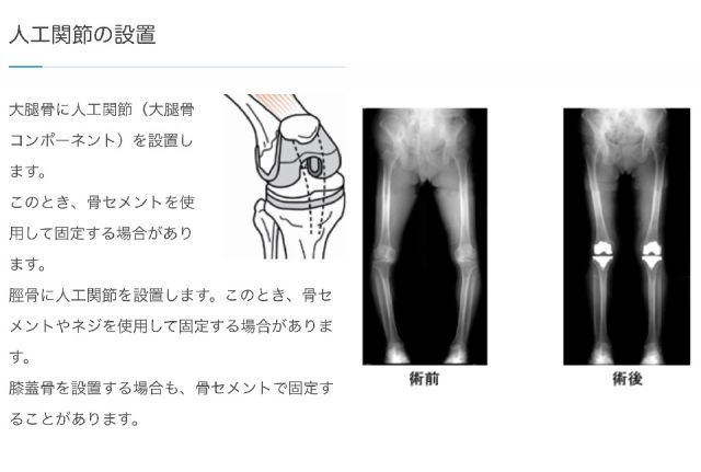 右膝関節の人工骨置換手術を受けました
